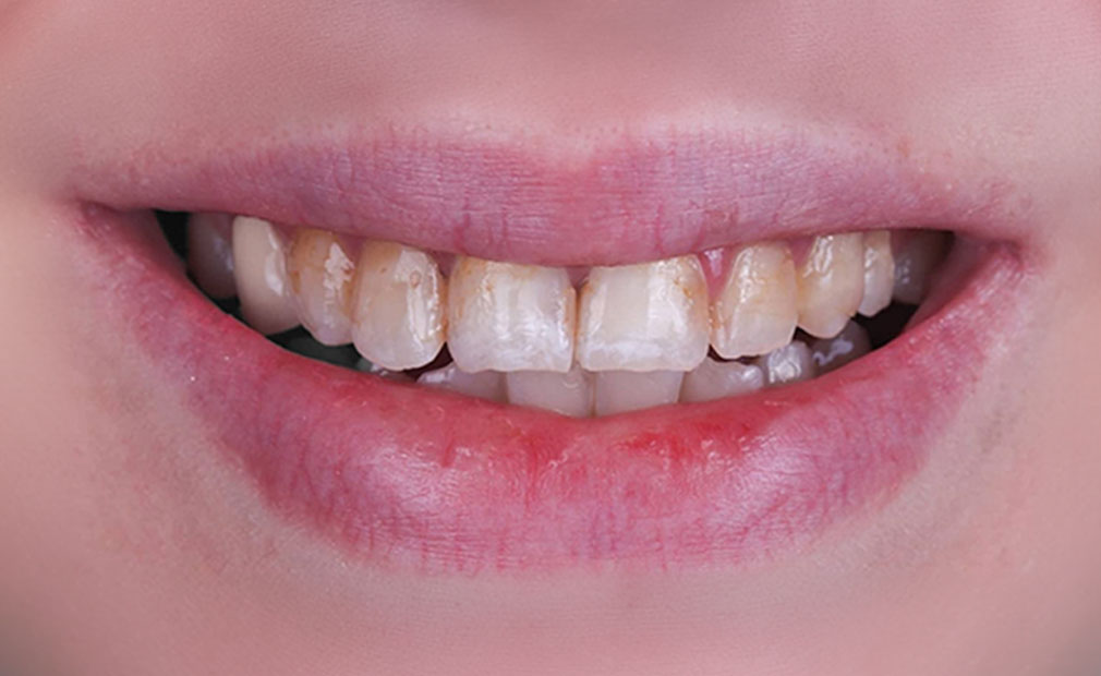 Clareamento Dental